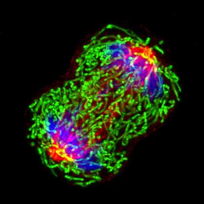 Dividing breast cancer cell Microscope image of chromosomes separating during cell division.