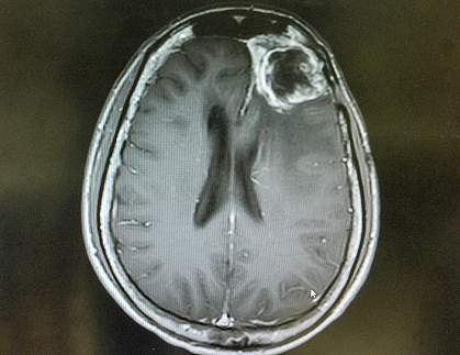 MRI of a gliblastoma. MRI of a gliblastoma.
