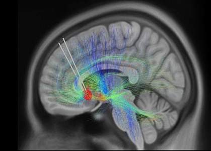 MRI scan of a brain with an implanted DBS device. MRI scan of a brain with an implanted DBS device.