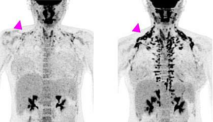 PET images of brown fat in woman’s body showing more brown fat on day 28 in regions between neck and shoulders. PET images of brown fat in woman’s body showing more brown fat on day 28 in regions between neck and shoulders.