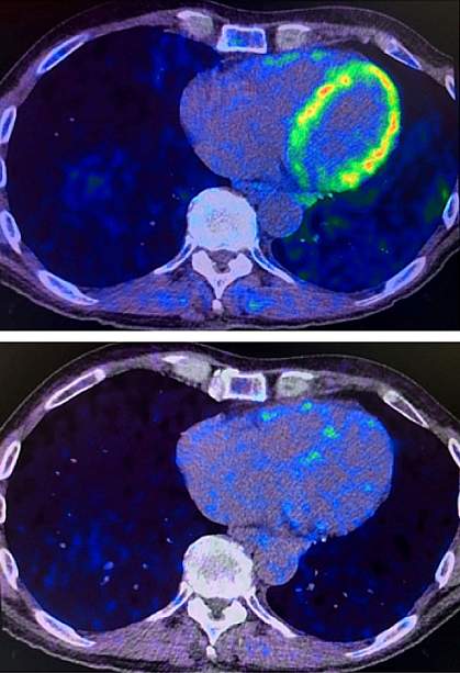 Heart PET scans from a study participant Heart PET scans from a study participant.