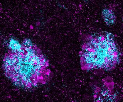 Lysosome clusters around amyloid plaques. Immunofluorescence image of purple clusters around loose light blue clusters.