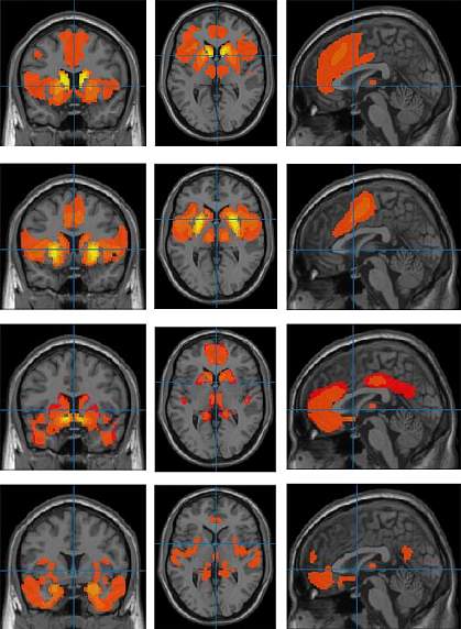 Brain images with red and yellow areas Brain images with red and yellow areas.