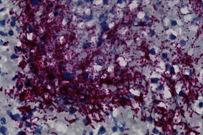 Microscope image of purple-stained bacteria throughout a tumor Microscope image of purple-stained bacteria throughout a tumor.