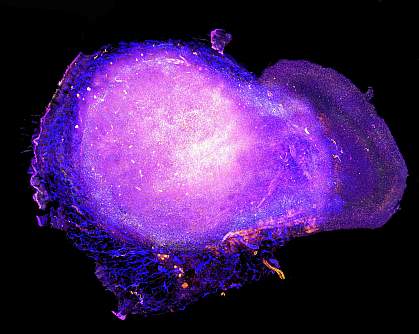 Transparent tumor tomograph image of numerous immune cells around a larger tumor Transparent tumor tomograph image of numerous immune cells around a larger tumor.