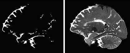 Side view showing perivascular spaces highlighted throughout a human brain. Side view showing perivascular spaces highlighted throughout a human brain.