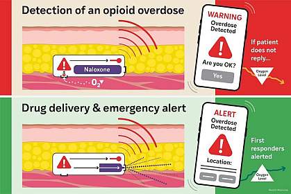 Schematic illustration of the implantable Naloximeter device. Schematic illustration of the implantable Naloximeter device shows that detection of an opioid overdose leads to a warning on a mobile device. If the patient doesn’t reply, the drug is delivered and first responders are alerted.
