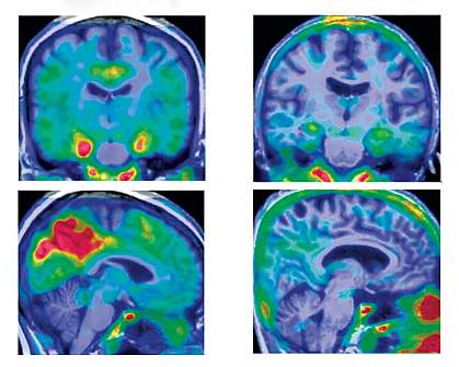 Brain tau levels Four tau PET brain images show larger areas of red in left two images