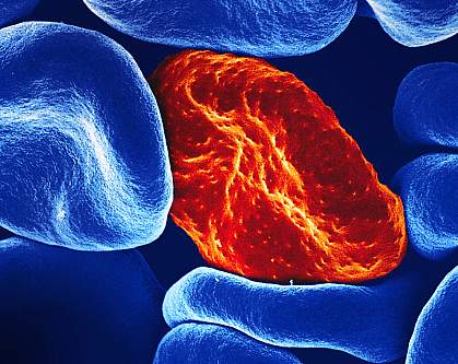 Red blood cell infected with malaria parasites. Colorized scanning electron micrograph of red blood cells. The one infected by malaria parasites has a rough surface, while the others are smooth.