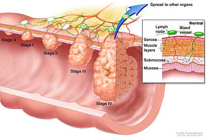 Illustration of colorectal cancer stages Illustration of colorectal cancer stages.