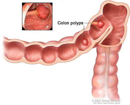 Illustration of colon polyps Illustration of colon polyps.