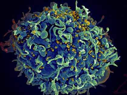 Scanning electron micrograph of HIV particles infecting a human T cell Scanning electron micrograph of HIV particles infecting a human T cell.