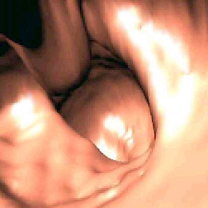 Screen shot from a virtual colonoscopy video Screen shot from a virtual colonoscopy video.