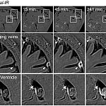 A series of MRI images showing the movement of light-emitting molecules moving through the arachnoid barrier. 