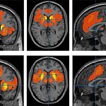 Brain images with red and yellow areas.